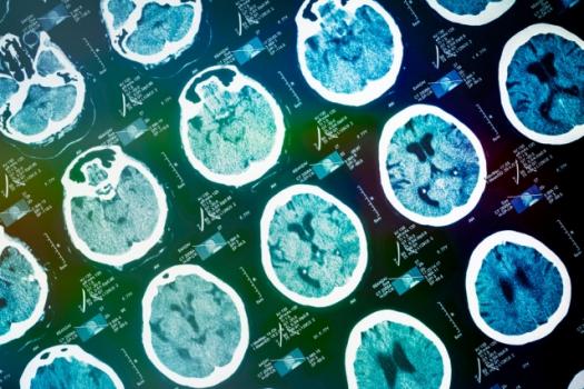 Combining MRI and other data helps machine-learning systems predict effects of neurodegenerative disease.