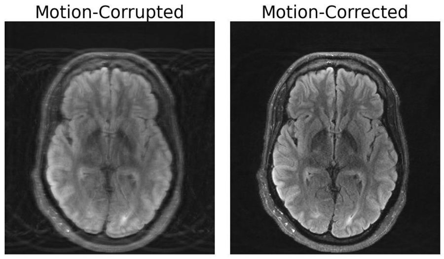 The image on the left depicts an MRI scan of the human brain corrupted by motion artifacts, whereas the image on the right depicts the same image with motion correction applied by a deep learning model developed by researchers at MIT (Credit: The researchers).