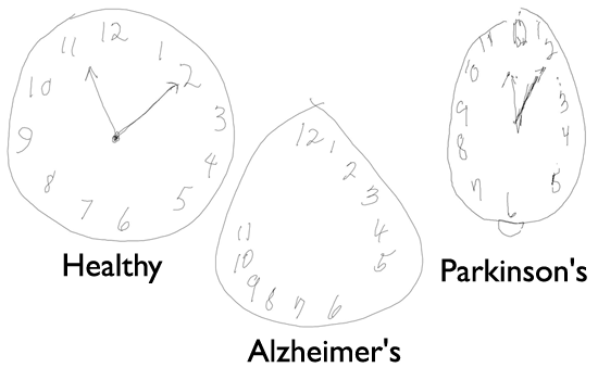 A CSAIL team has demonstrated the ability to detect Parkinson's, Alzheimer's and other dementias using AI and a digital pen.