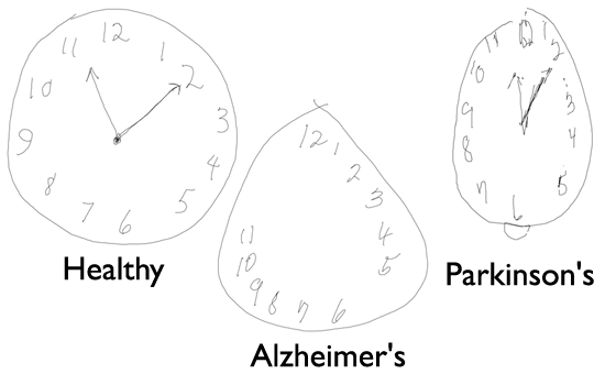 CSAIL/Lahey team studies how digital tools and AI can help detect dementia and other cognitive disorders earlier than ever before.