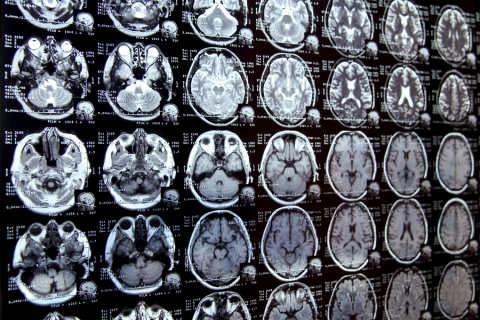 MIT researchers have developed a new AI-based tool that rapidly annotates areas of interest in medical images and can help in the study of new treatments or map disease progression (Credits: iStock).