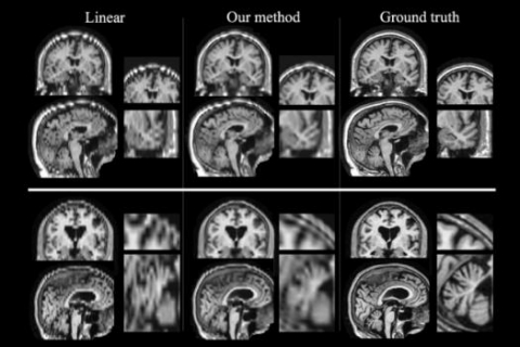 Researchers at MIT and other institutions have devised a way to boost the quality of low-resolution patient MRI scans so they can be used for large-scale studies.